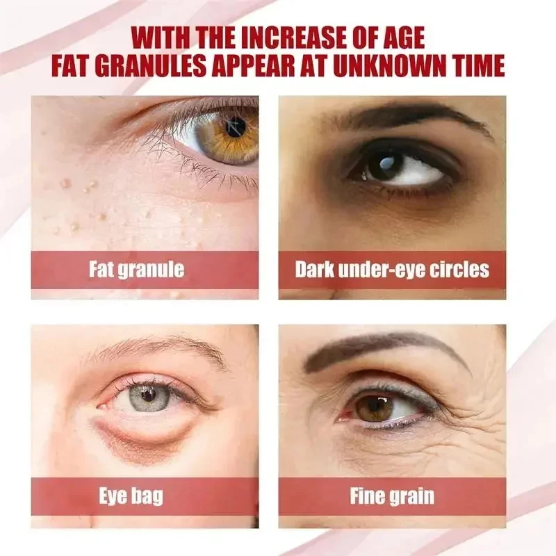 Eye Cream for Fat Granules Puffiness - Milia Remover Skin Repair