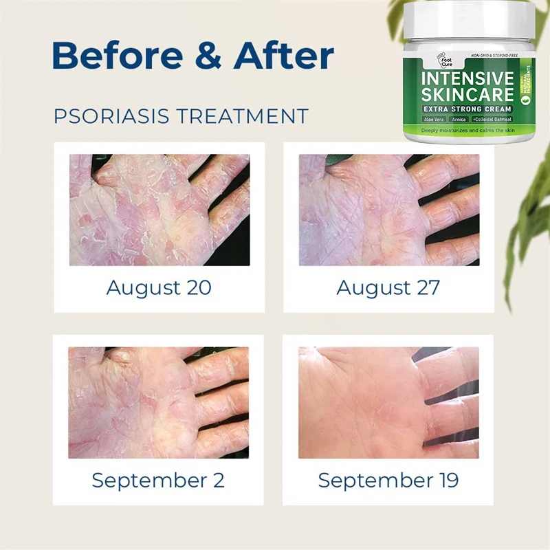 Natural Plant Extract Psoriasis Dermatitis Eczematoid Eczema Ointment Anti-Itch Chinese Herb Medical Skin Care Cream 15/30/50g