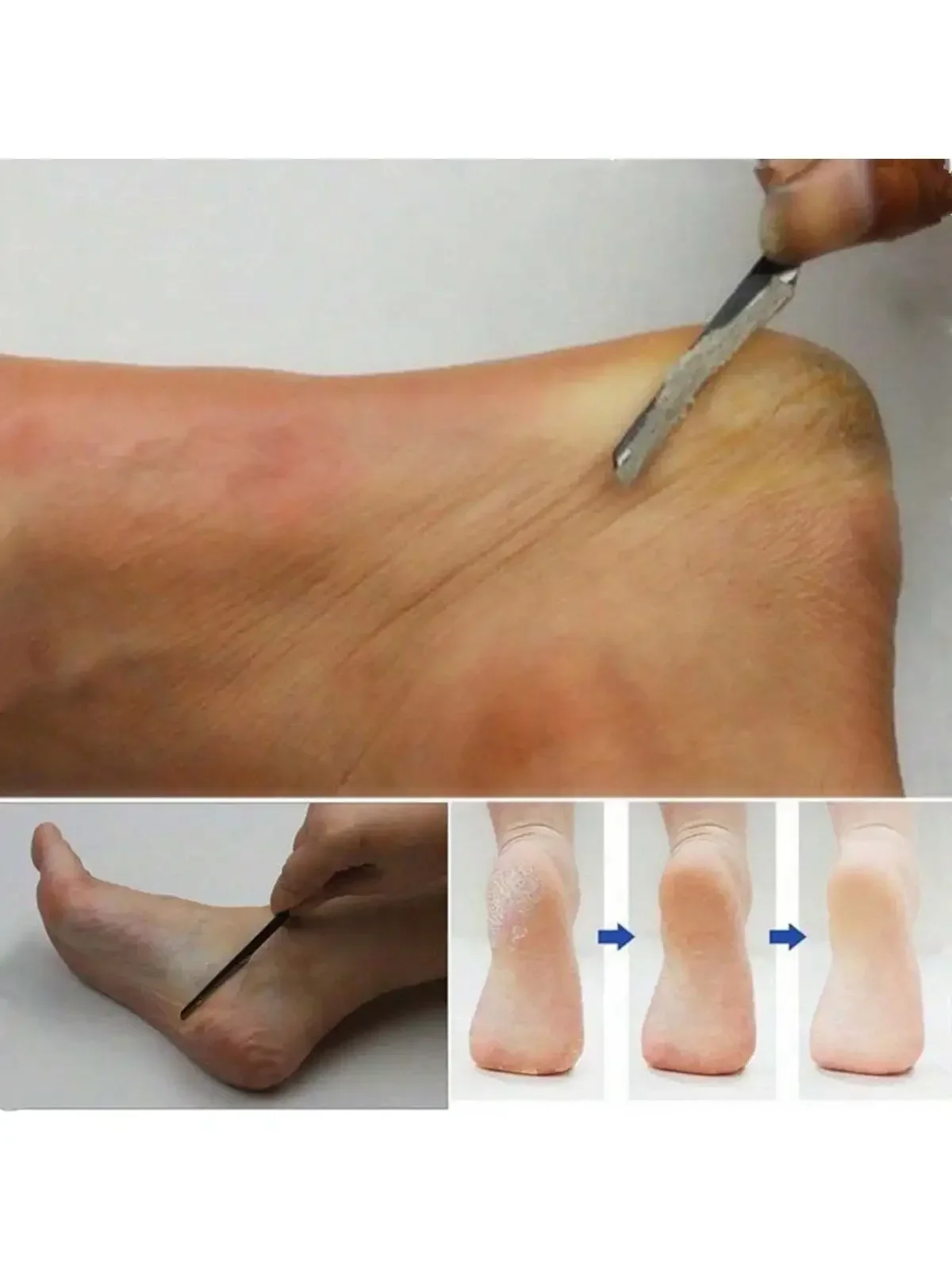 Cuticle Removal Toenail Scissors Foot Care Tools Stainless Steel Nail Kit Professional Pedicure Knife Set 2 Pieces