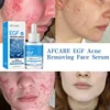 Oligopeptide Anti Acne Face Serum EGF Acne Treatment Essence Diminish Pigmentation Moisturizing Skincare Repair Skin Barrier 1