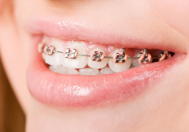 Tratamiento De Ortodoncia Dental, Tipodonto Dental Con Soportes De - Foto 3