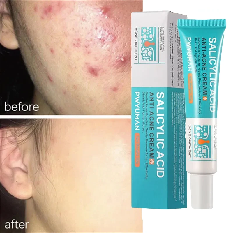 

Salicylic Acid Acne Removal Cream Effective Anti-acne Treatment Repair Scar Gel Shrink Pores Oil Control Moisturizing Skin Care
