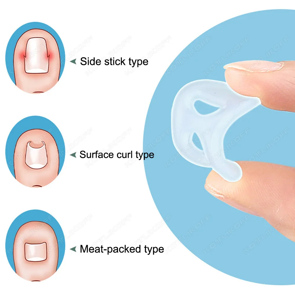 Silicone Ingrown Toenail Correction Tool Invisible Straightening Protector Durable reusable