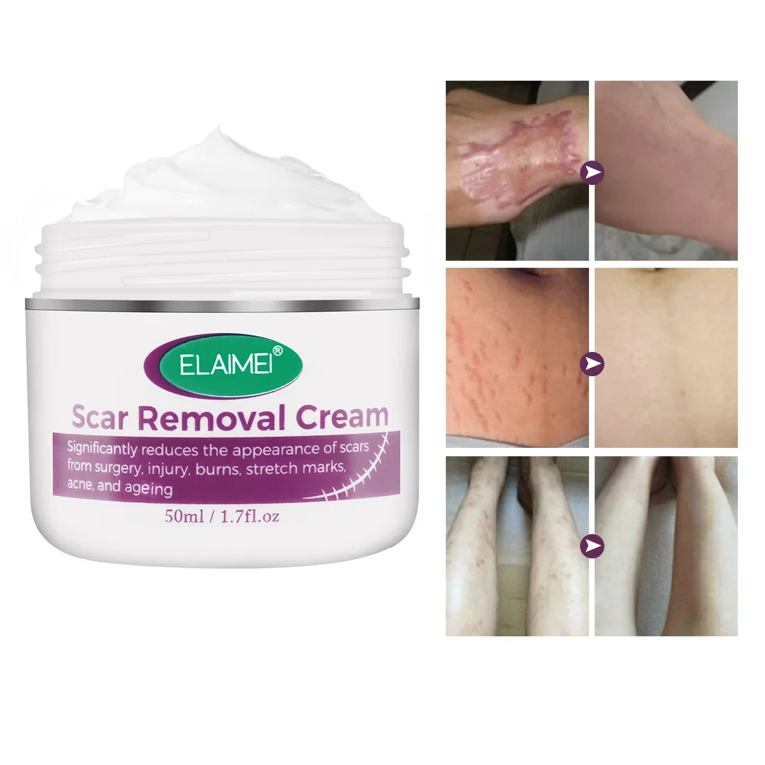 ELAIMEI Scar Removal Cream For New and Old Scars,Stretch Mark Removal Gel Ointment, Multiuse