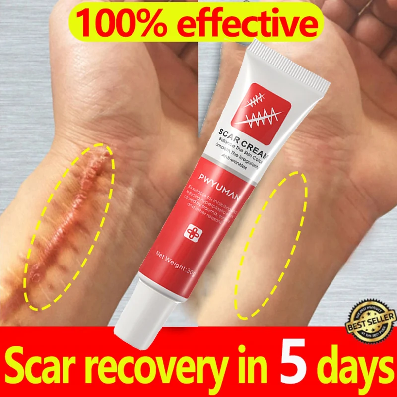 

Scar Removal Cream Treatment Stretch Marks Burn Surgical Scar Ointment Repair Gel Remove Acne Spots Whitening Smooth Skin Care