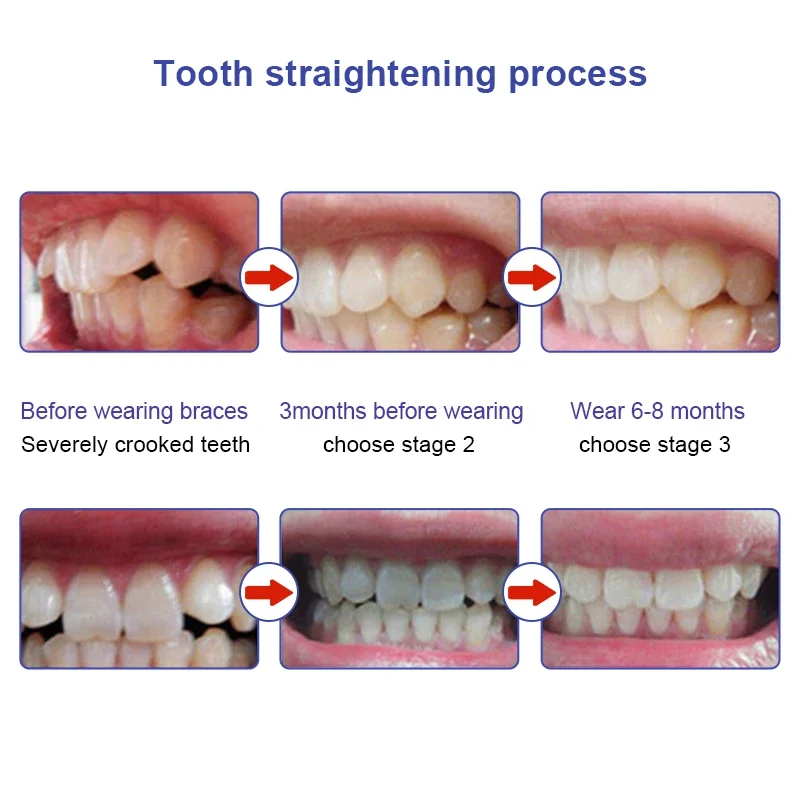 1/3 szt. Korektor zębów do zębów z aparatem ortodontycznym trenera fałszywych aparatów ortodontycznych do wyrównywania zębów 3 fazy dla dorosłych narzędzia pielęgnacja zębów