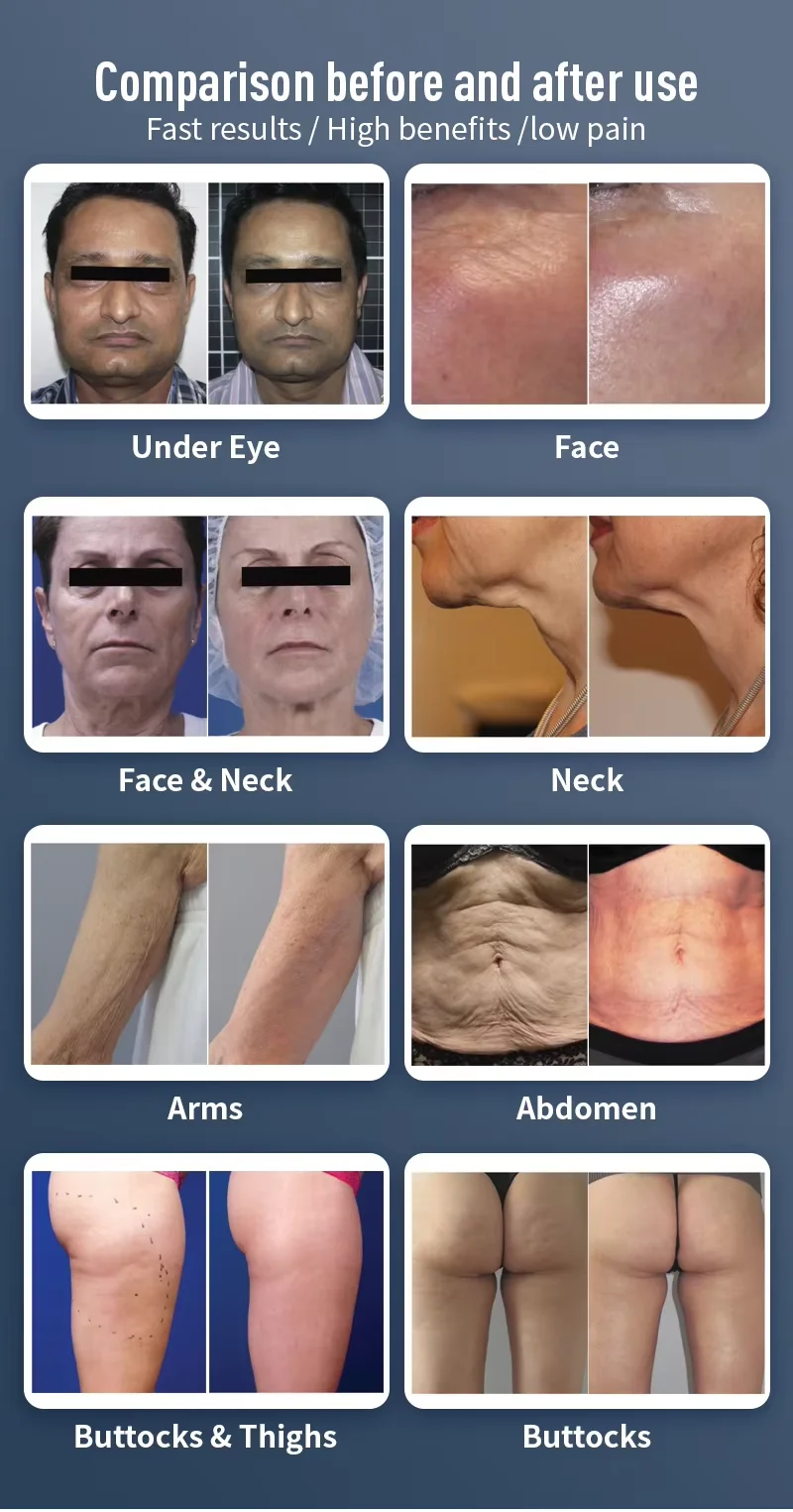 Actimel Venus Legacy Equipment 4D Vela Hautstraffung Vakuum Abnehmen Cellulite Entfernung Vakuum Legacy Skin Lifting SPA Gerät – Detail 10