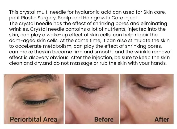 Korea Micro nano34G Spritzenverbinder 3Pin Einweg-Augenlidwerkzeuge – Detail 5