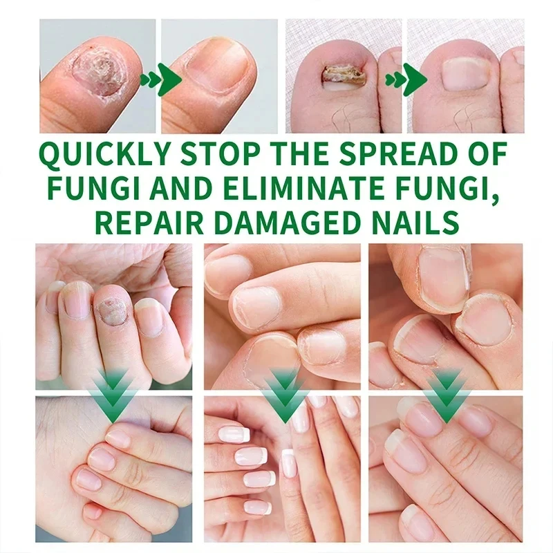 7 Day Nail Fungal Treatment Serum Foot Toe Nail Fungus Removal Essential Oil Anti Infection Onychomycosis Paronychia Repair Gel nail fungus remover