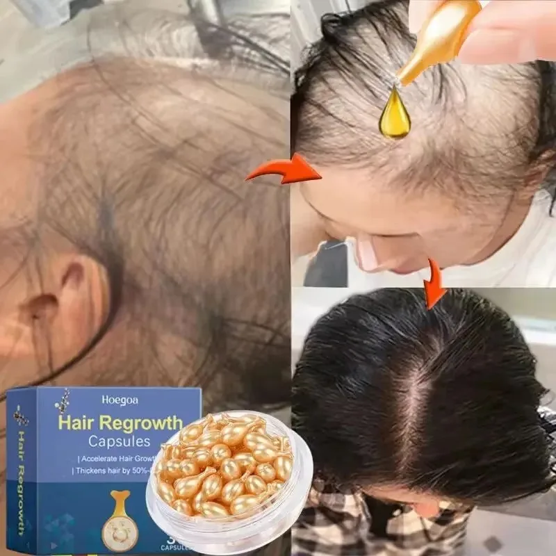 Hair Growth Oil Vitamin Capsule 7 Days Fast Regrowth Anti Hair loss Baldness Repair Damaged Scalp Treatment For Women Men