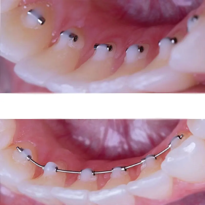 Trapano Odontotecnico 10 Fermi A Gancio Crimpabili Per Ortodonzia - AZDENT, Per Apparecchi Dentali Stop Panda