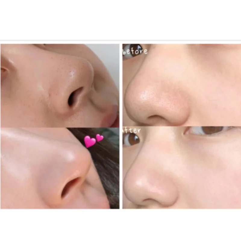 Rechargeable electric blackhead acne Black dots remover pore facial cleanser Korean skin care tag removal tool 3