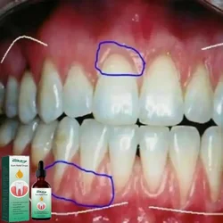 Repair Cavity Essence Fast Cavity Repair Clean Teeth Teeth Whitening Remove Yellow Plaque Reduce Gums Cavities Toothache 30ml