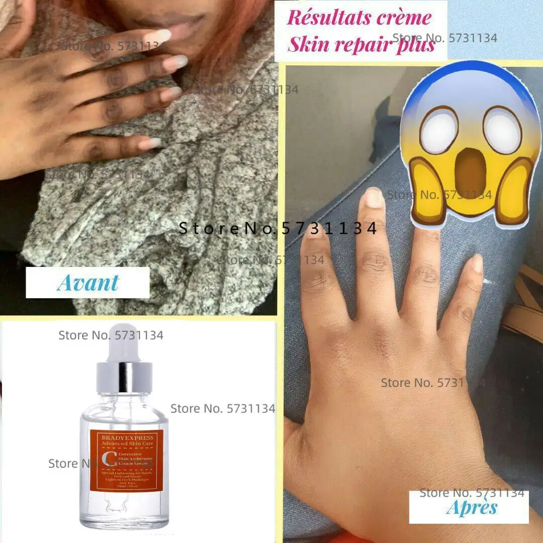 Corrective Skinlightening Cream For Hyperpigmentation For Hands, Feet