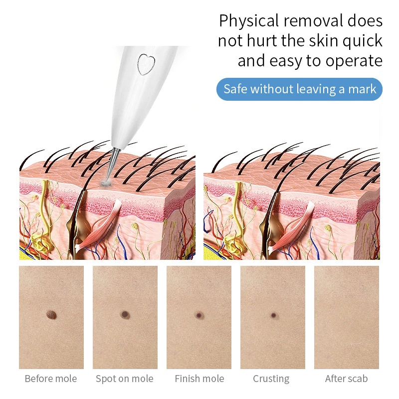 Freckle Remover Machine Mini Laser Plasma Pen Mole Removal Dark Spot Remover Skin Wart Tag Tattoo Remaval Tool Beauty