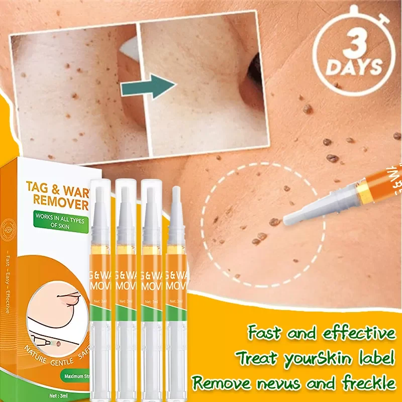 

Mole Removal Anti Wart Remover Liquid Pen - Treatment Papilloma Removal Wart Treatment Solution on Skin
