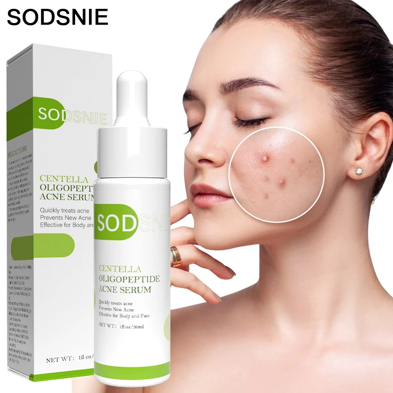 

Anti-Acne Serum Face Serum Repair Nourish Remove Blackheads Acne Marks Improve Rough Whitening Skin Care Oligopeptide 30ml