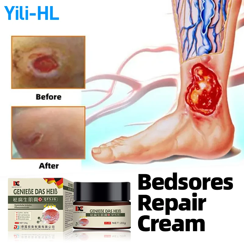 

Germany Bedsores Remove Rots Myogenic Cream Anti Bed Sore Wound Healing Treatment Ointment Pressure Ulcer Decubitus Medicine
