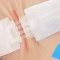 Portable Zipper Tie Wound Closure Patch Hemostatic Patch Wound Fast Without Suture Zipper Outdoor Band-Aid Quick Clot