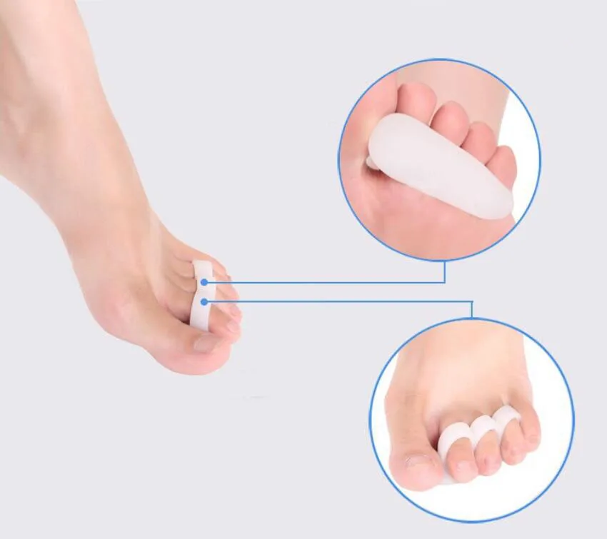 1 external correction device for repairing toe and toe separator toe separator toe separator