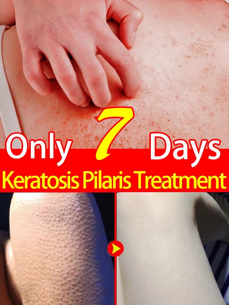 KPBumpEraserBodyScrubExfoliantForKeratosisPilarisTreatment.jpg