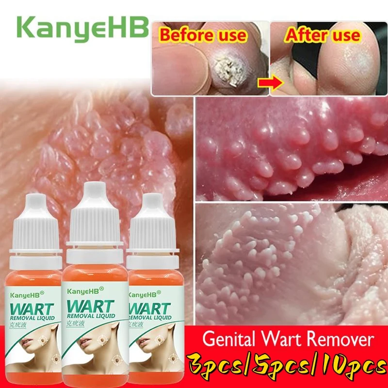 

Painless Medical Liquid Warts Skin Tags Removal Private Parts Genital Wart Antibacterial Serum Papilloma Treatment Beauty Health