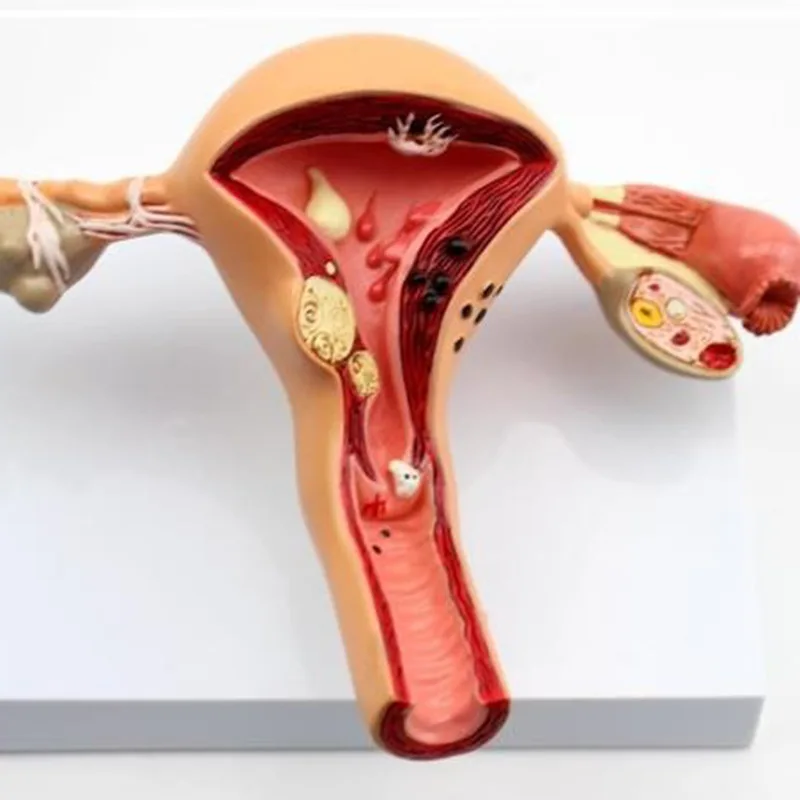 인간 자궁 해부학 모델, 자궁 병변 모델, 병적 자궁 모델, 자궁 난소 병변