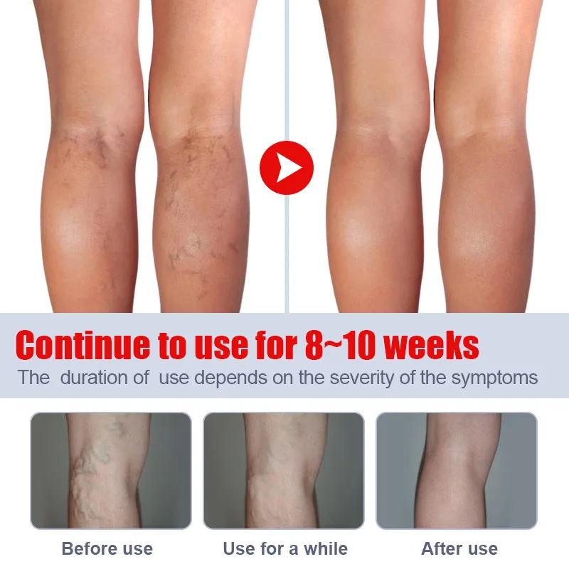 20g Varicose Vein Relief Cream Improves Blood Circulation Relaxing Leg Cream Relieve Spider Blood Vessels Anti Varicose pain analgesic cream varicose veins patch
