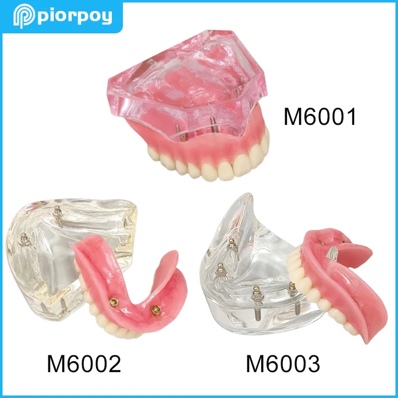 DentalTeachingModelRemovableOverdentureNISSINKilgoreStyle