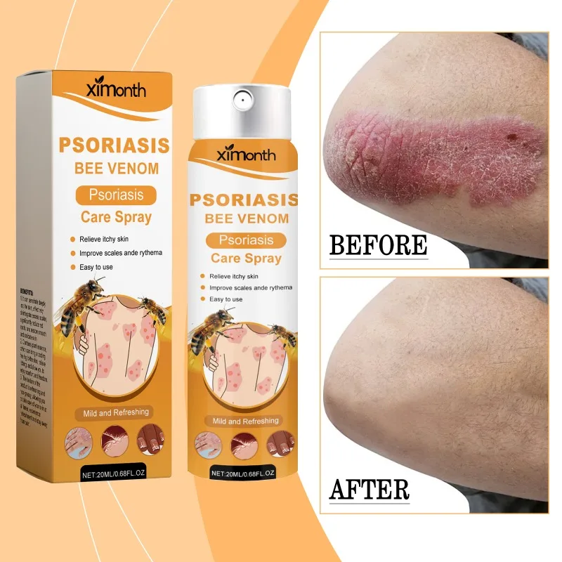 Skin Psoriasis Spray Natural Herb Eczema Treatment Spray Itch Relief Improve Redness Dermatitis Psoriasis Health Care 20ml