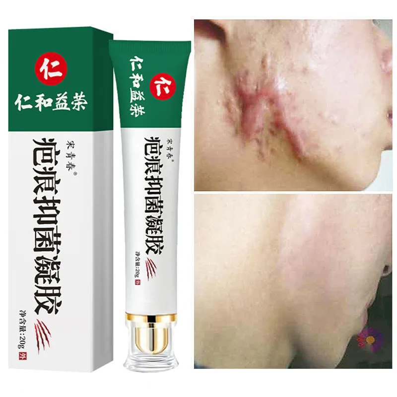 Acne Scar Removal Face Cream Spots Pigmentation Corrector Whitening Anti Stretch Marks Repair Gel Skin Care |