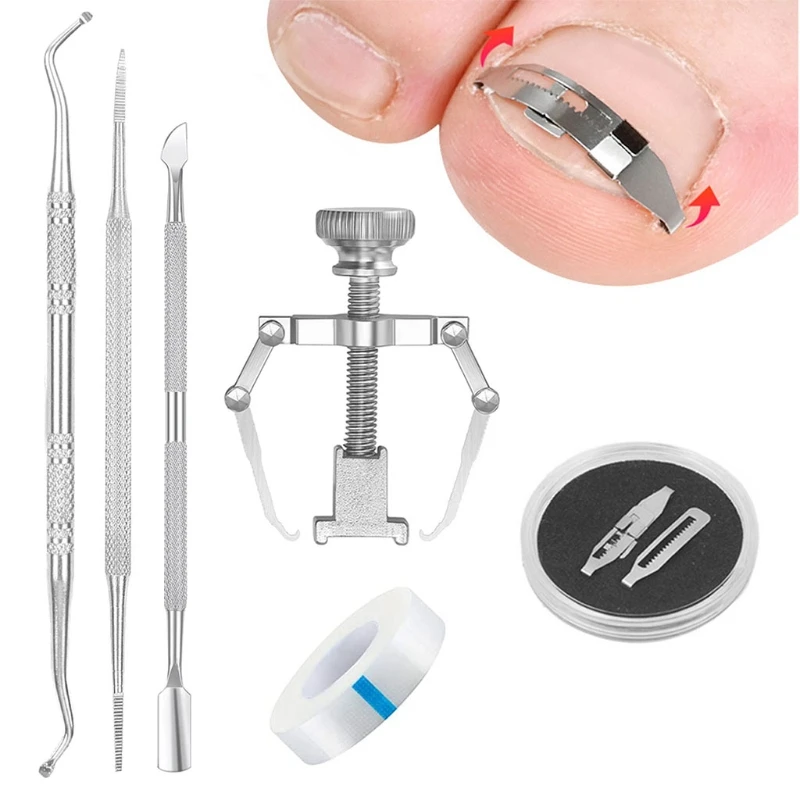 Ingrown Toenail Corrector Buckle Corrector Ingrown Toenail Tool Drop Shipping