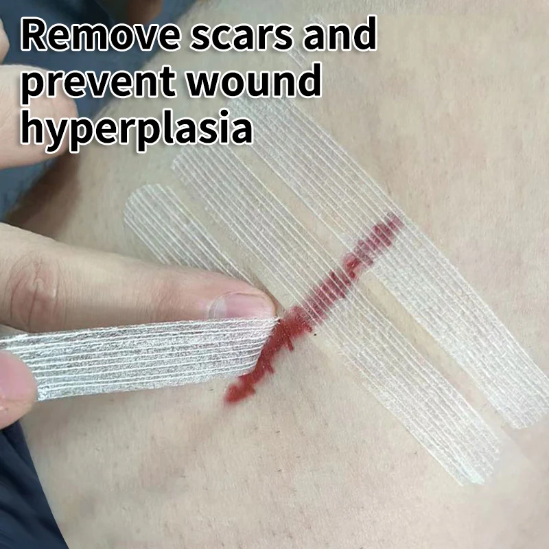 Steri Strip Wound Skin Closure Strips Surgical Sutures Postpartum Wound Repair Cosmetic Surgery