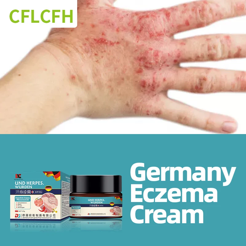 

Eczema Treatment Cream Germany Medicine Psoriasis Dermatitis Eczematoid Fungus Antibacterial Anti-itch Pompholyx Herbal Ointment