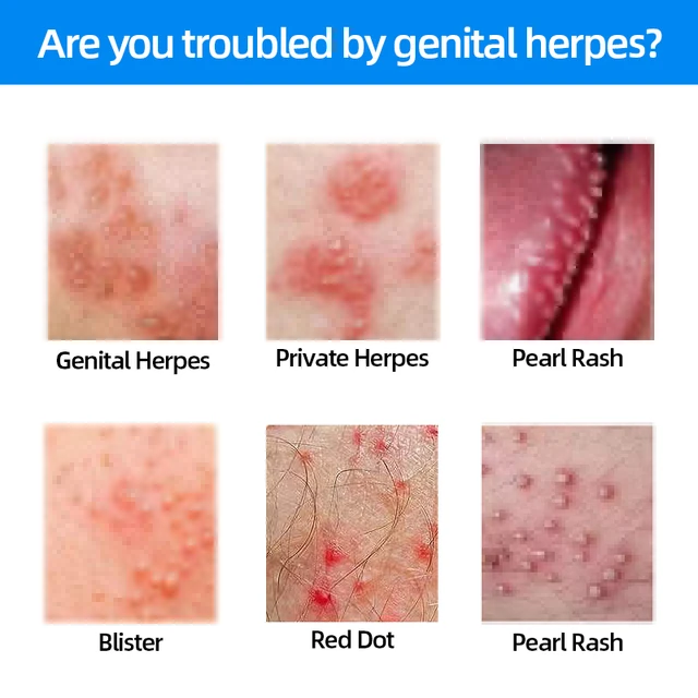 anal-fissure-herpes