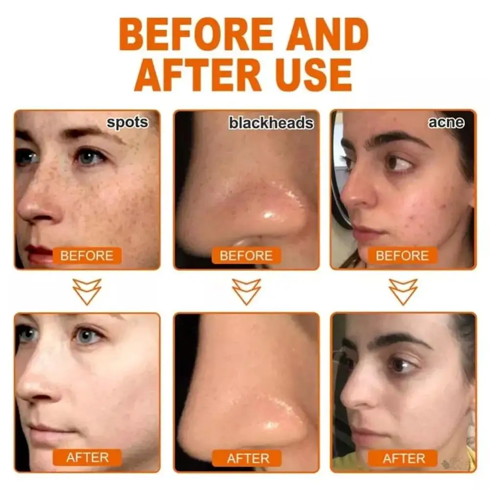 Description Picture 4 of itemPack of 2 Spots Blemish Clearing Peel Off Mask Anti-Blemish Freckle Glowing Mask Tear-Off Face Mask Moisturizing Pore Tightening