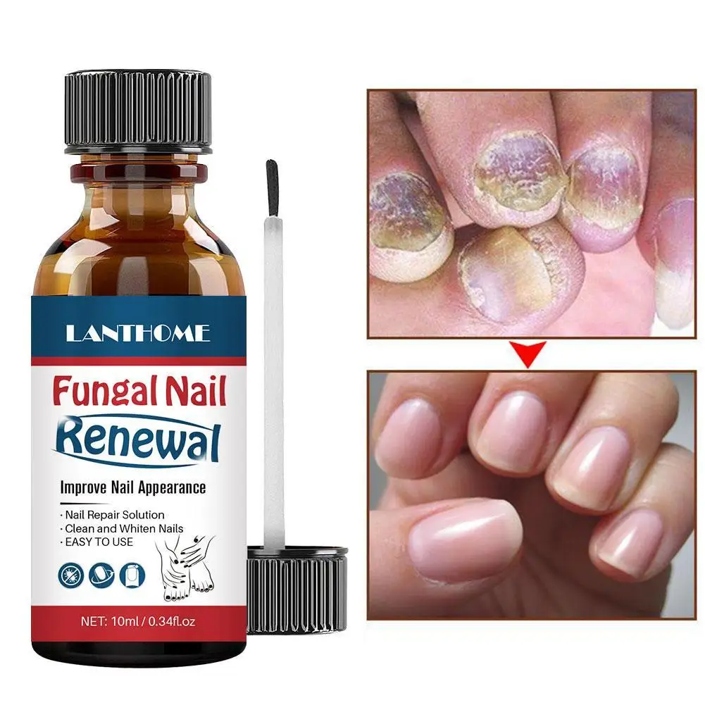10ml LANTHOME Nail Fungal Treatment Feet Care Essence Anti Infection Paronychia Onychomycosis Foot Toe Nail Fungus Removal