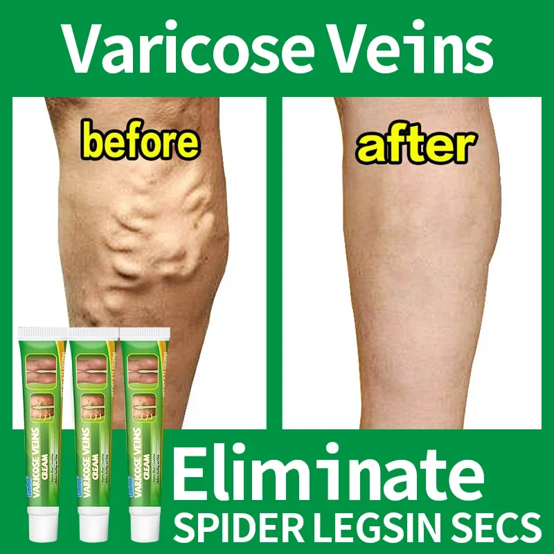 Effective Varicose Vein Relief Cream Ointment for Varicose Veins to Relieve Vasculitis Phlebitis Spider Pain Relief varicose vein ointment