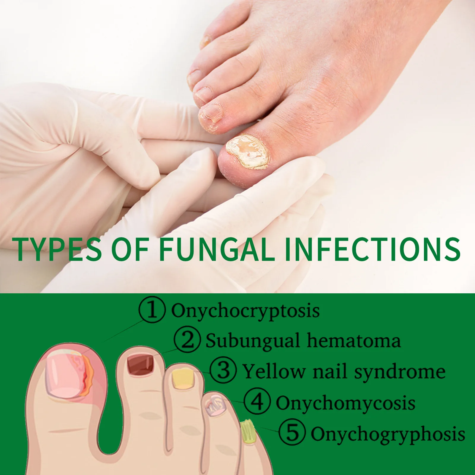 Nail Fungus Remover Personal Health Care Manicure Pedicure Tools Nail Fungal Treatment Device 1-5Pcs