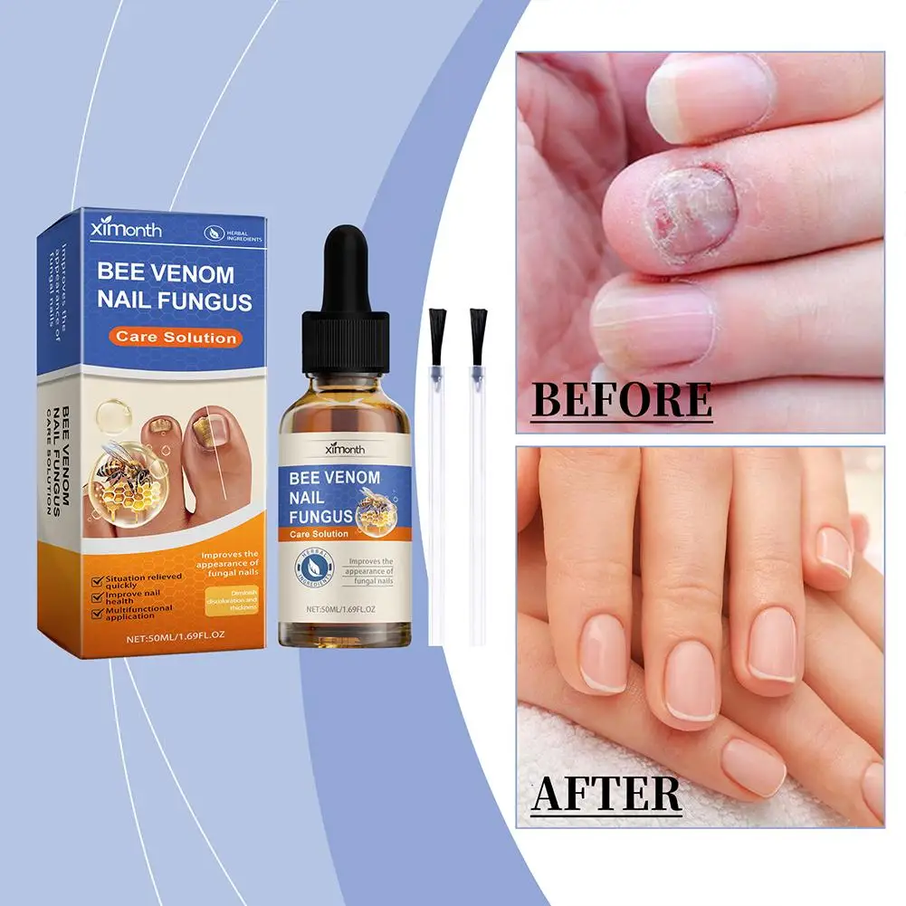 Nail Repairing Liquid Fungus Treatment Essence Care Fungal Gel Paronychia Anti-infective Foot Removal Hand Repair M7C3 50ml