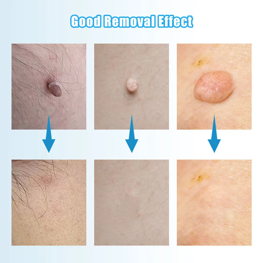 2 In1 Skin Tag Mole Wart Removal Kit Cleaning Tools Skin Care Wart Treatments Remover