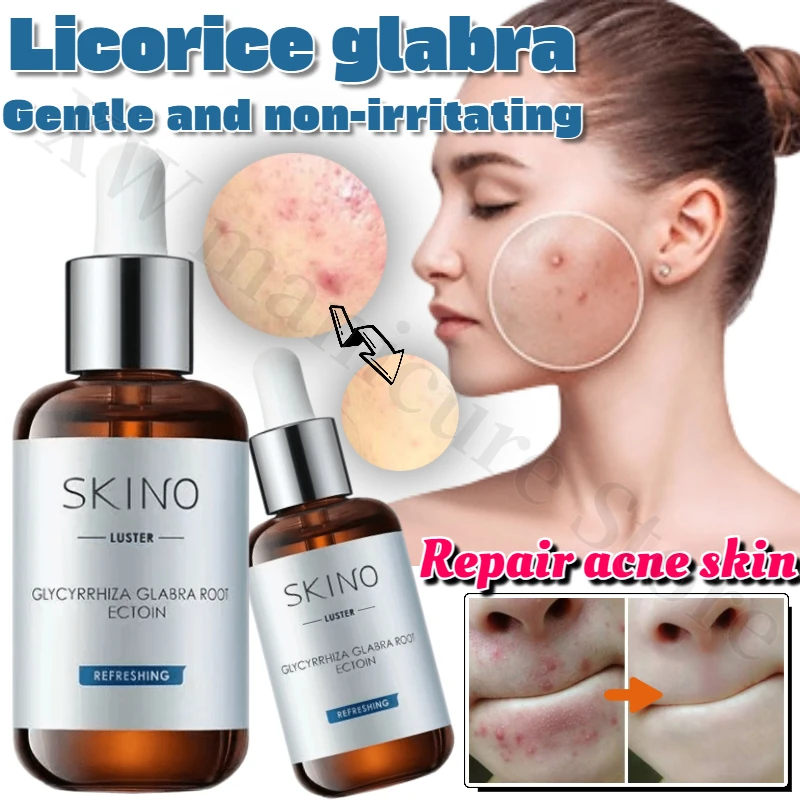 

Licorice Glabra Essence Removes Acne Marks Niacinamide Fades Red and Black Acne Marks Soothes and Repairs Damaged and Red Kin.