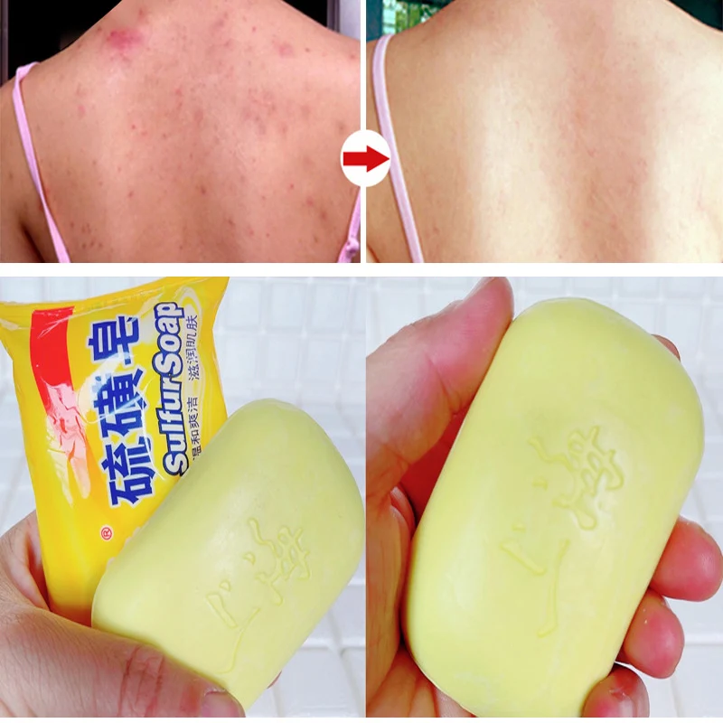 

85g Shanghai Sulfur Soap Oil-Control Acne Treatment Psoriasis Seborrhea Eczema Anti Fungus Bath Healthy Soaps Eczema
