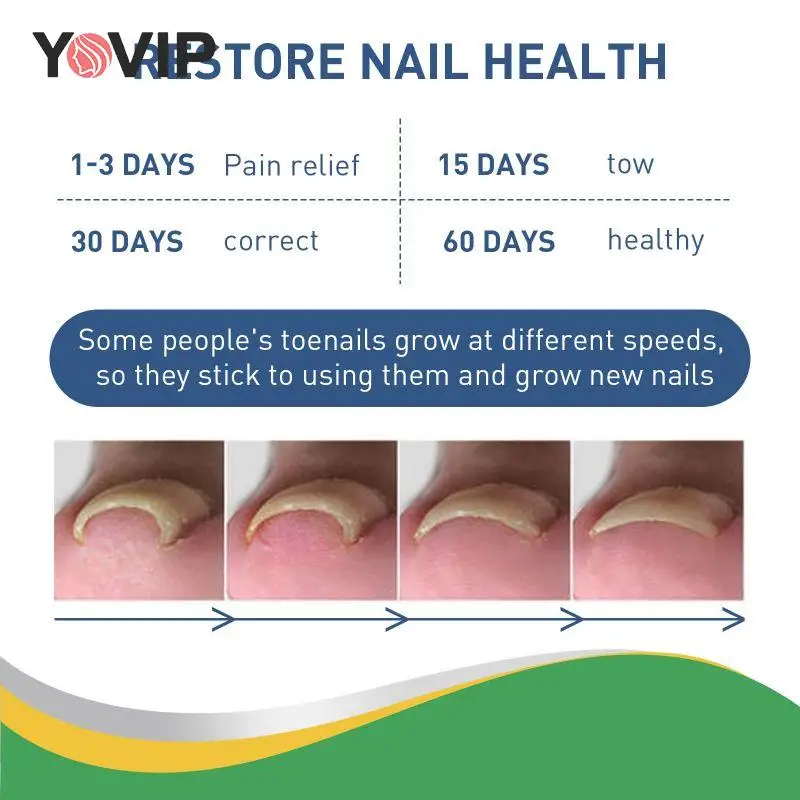 

Патчи для вросших ногтей, 50 палочек для ухода за вросшими ногтями, паронихия, восстановление ногтей, палочки для ногтей, лечебные принадлежности, инструмент для ухода за ногами