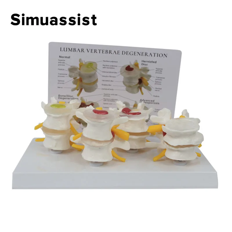4-stage Pathological Human Lumbar Spine Anatomy Model Medical Science Teaching Resources