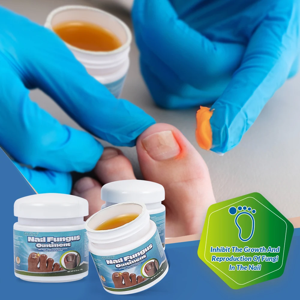 20G/box Sumifun Nail Fungus Treatment Cream Herbal Extract Paronychia Onychomycosis Repair Ointment Anti Infection Foot Care antibacterial anti fungal cream,nail fungus treatment patches