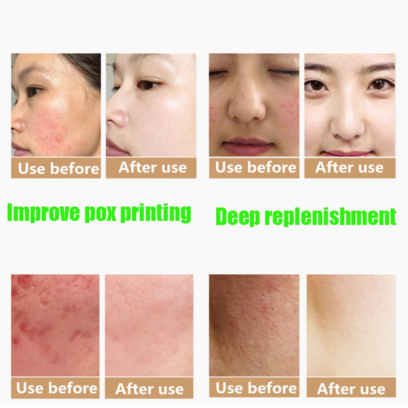 Snail Mucus Snail Slime Extract Anti-Wrinkle,Effectively Skin Whitening And Moisturizing Same As Crawling On The Face
