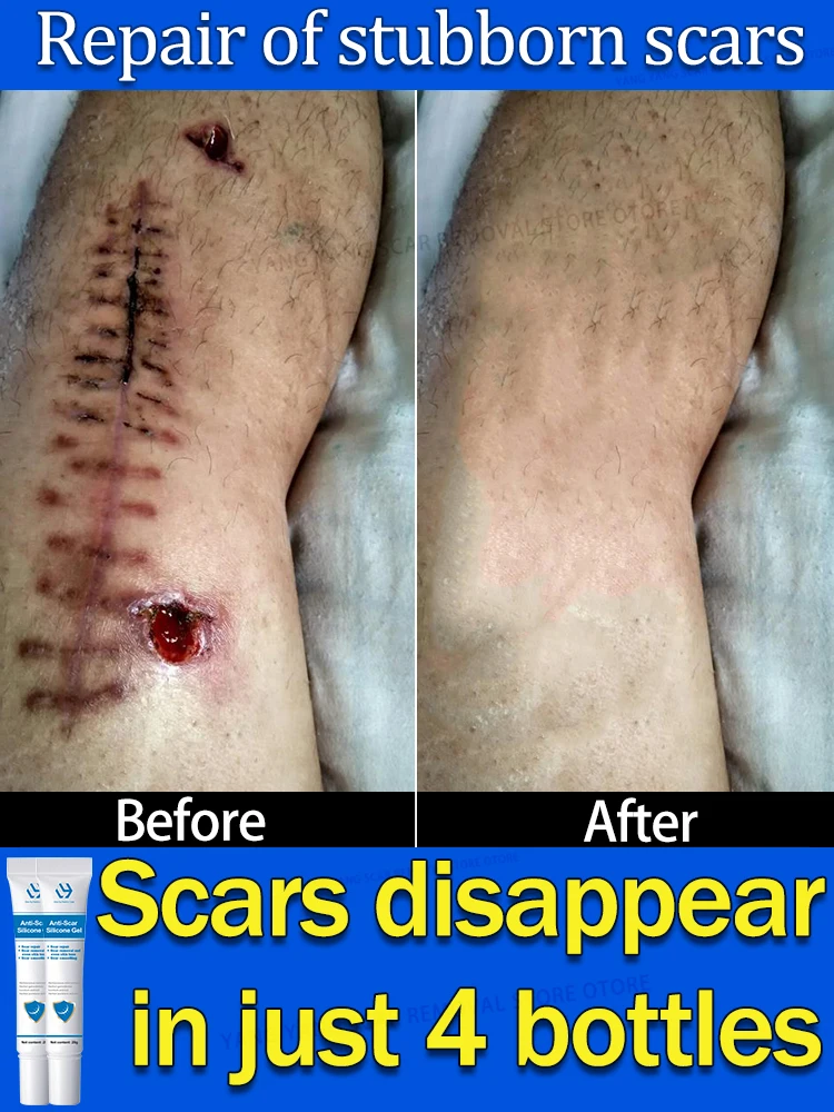 

Scar Removal Cream For Old Permanently Mark Healing To Gel Ointment