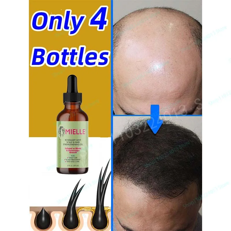 

Fast hair growth promoter products Hair loss Hereditary Seborrheic alopecia treatment oil For Hair growth essence Natural safety