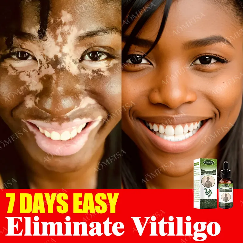Herbal Extract Vitiligo Ointment Remove Ringworm White Spot Removal